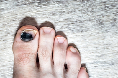 Managing a Bruised Toenail