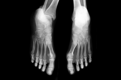 Understanding Metatarsal Stress Fractures